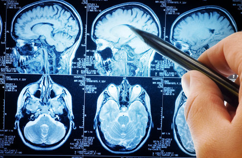Neurological-Inflammation